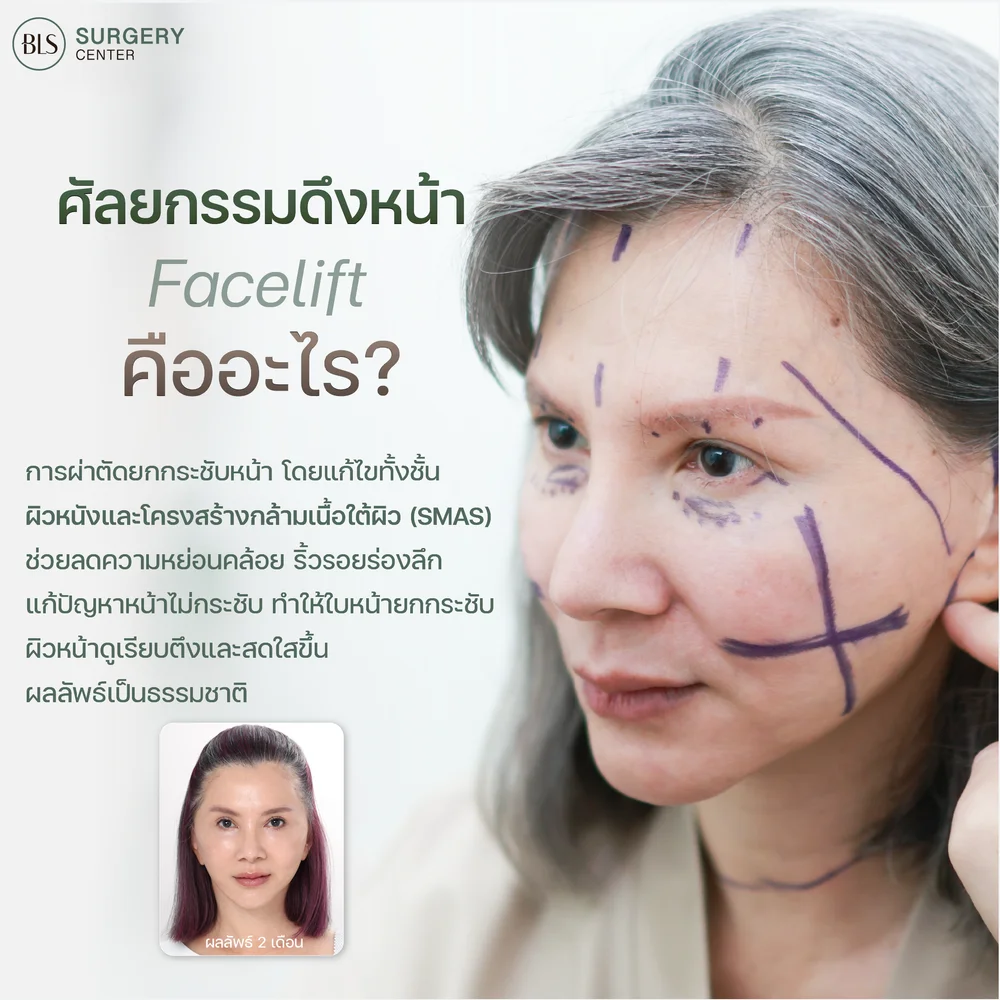 ดึงหน้า คืออะไร ทำไมต้องดึงหน้ากับศัลยแพทย์ตกแต่ง
