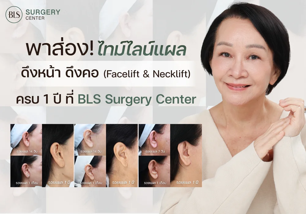 พาส่องไทม์ไลน์แผลดึงหน้าดึงคอ (Facelift & Necklift) ครบ 1 ปี ที่ BLS Surgery Center