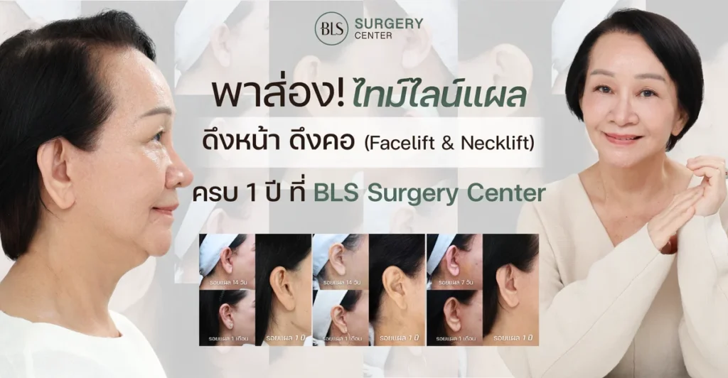 พาส่องไทม์ไลน์แผลดึงหน้าดึงคอ (Facelift & Necklift) ครบ 1 ปี ที่ BLS Surgery Center