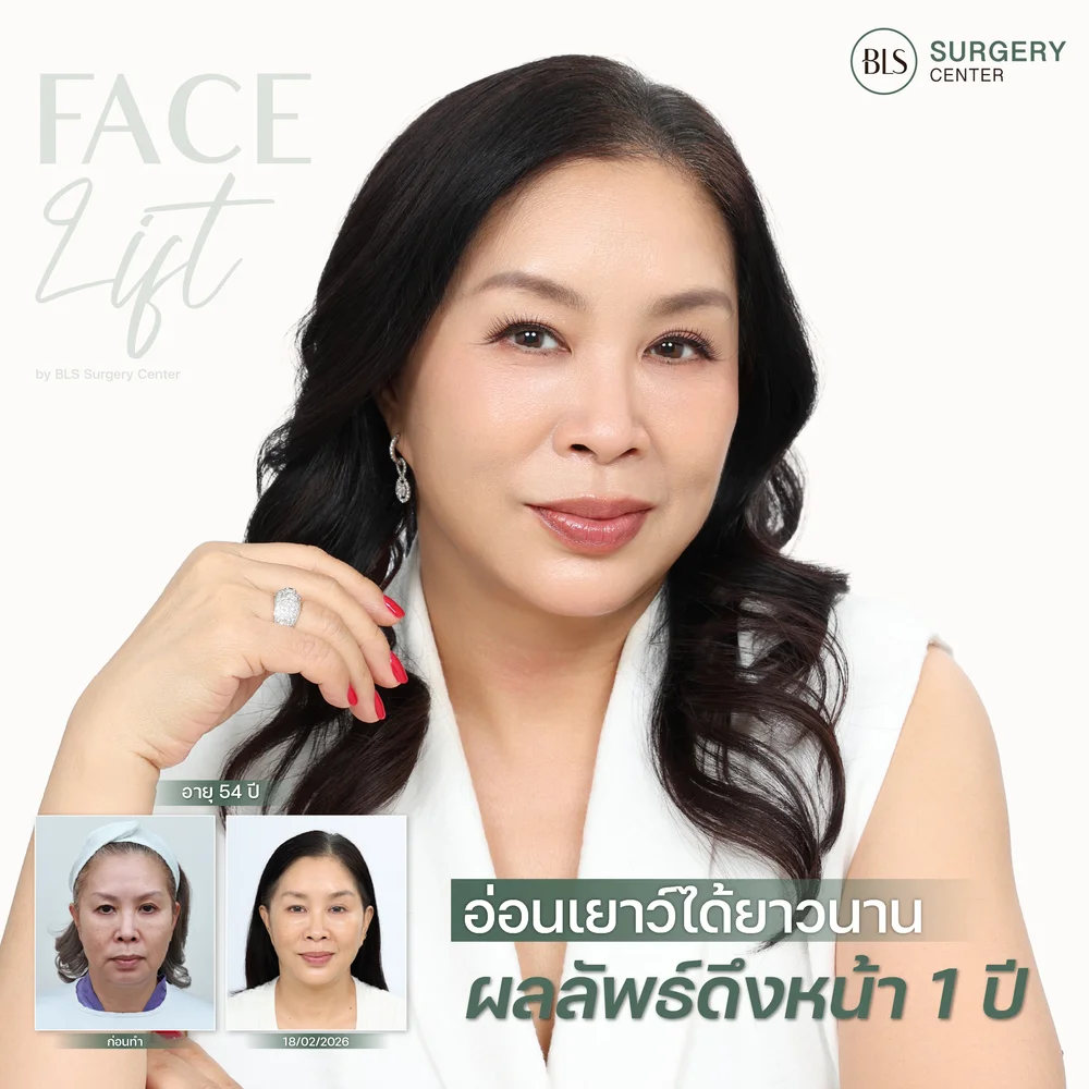 ยกกระชับใบหน้า ผลลัพธ์ผ่าตัดดึงหน้า