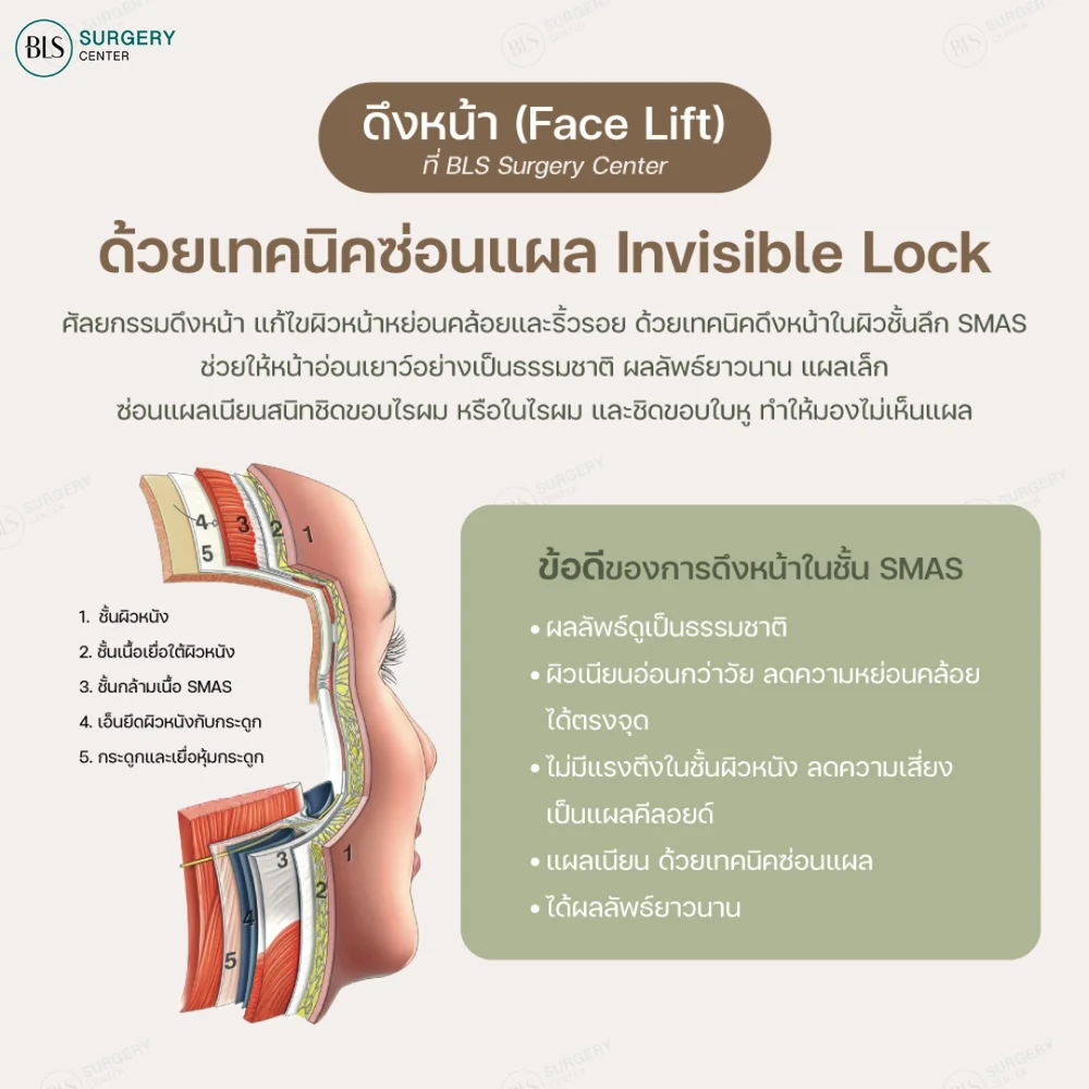 โครงสร้างใบหน้าที่เกี่ยวข้องกับการดึงหน้า