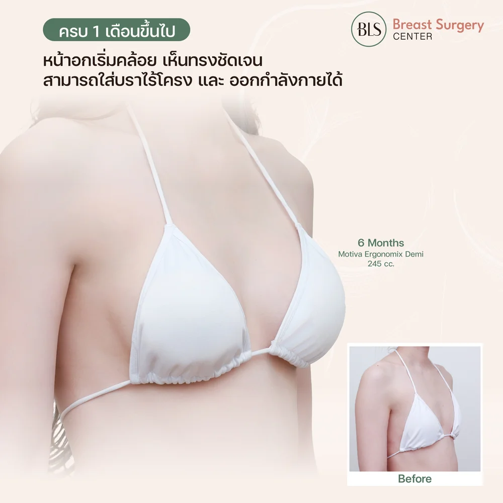 คลินิกศัลยกรรมหน้าอกที่เน้นการพักฟื้นสั้น