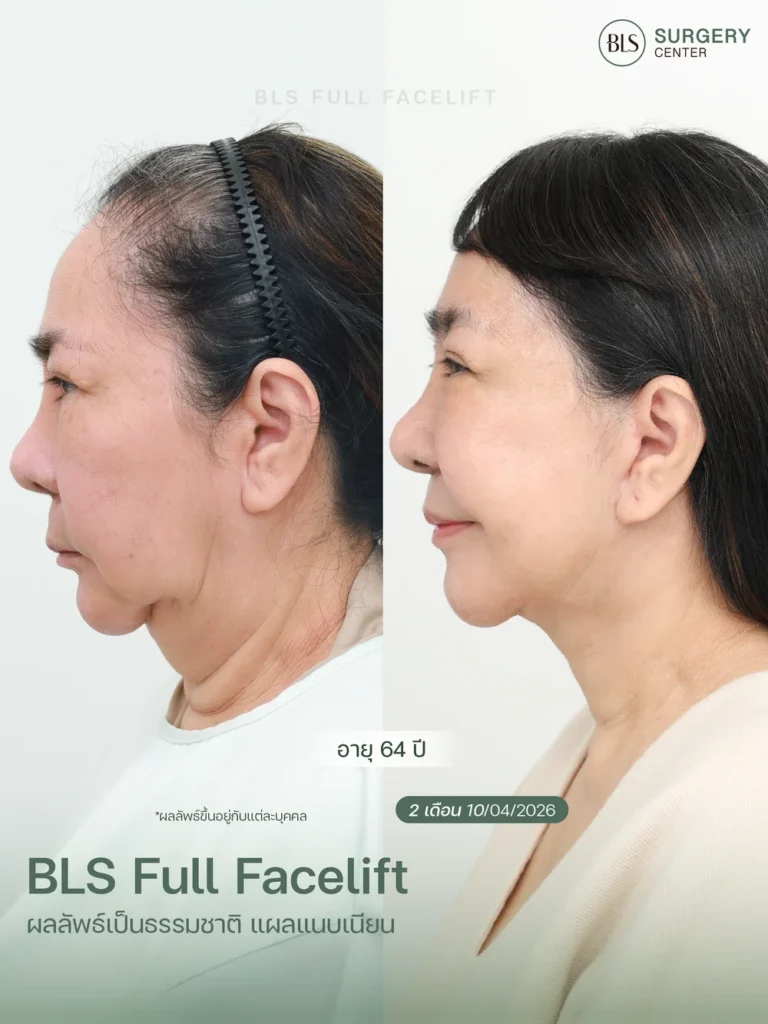 รีวิวศัลยกรรมดึงคอ Necklift ผลลัพธ์หลังผ่าตัด 2 เดือน ช่วยให้ลำคอดูกระชับและแนวกรามชัดขึ้น
