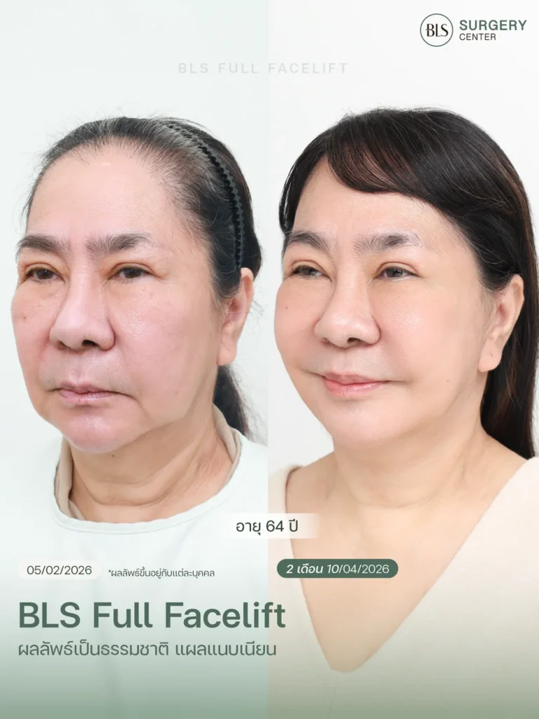 รีวิวศัลยกรรมดึงคอ Necklift ผลลัพธ์หลังผ่าตัด 2 เดือน ช่วยให้ลำคอดูกระชับและแนวกรามชัดขึ้น