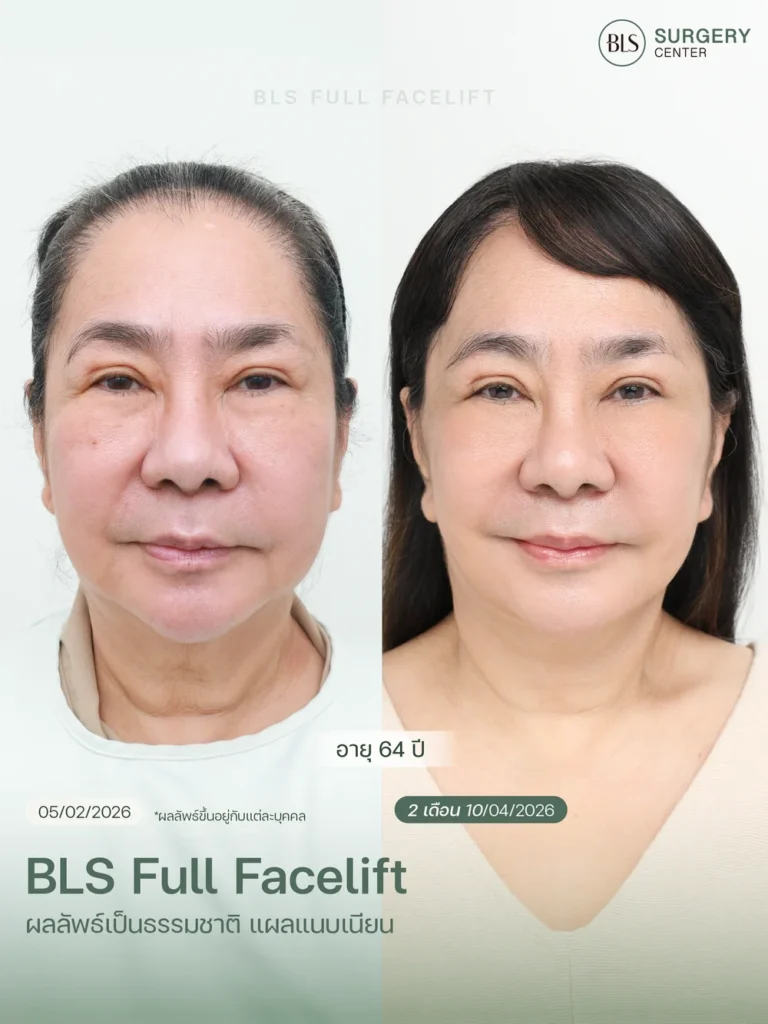 รีวิวศัลยกรรมดึงคอ Necklift ผลลัพธ์หลังผ่าตัด 2 เดือน ช่วยให้ลำคอดูกระชับและแนวกรามชัดขึ้น