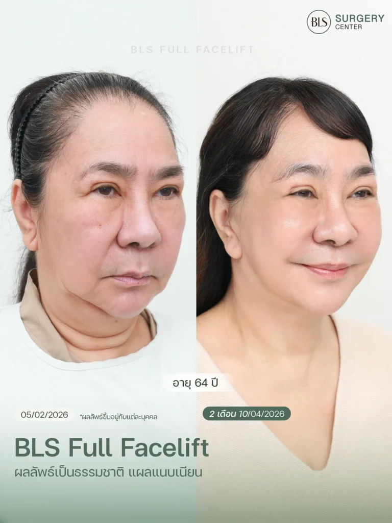 รีวิวศัลยกรรมดึงคอ Necklift ผลลัพธ์หลังผ่าตัด 2 เดือน ช่วยให้ลำคอดูกระชับและแนวกรามชัดขึ้น