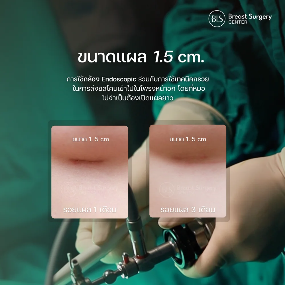 ส่องกล้องเสริมหน้าอก แผลขนาดเล็ก