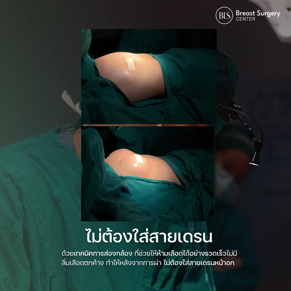 ส่องกล้องเสริมหน้าอก แผลเล็กเจ็บน้อย ไม่ต้องใส่สายเดรน ฟื้นตัวไว