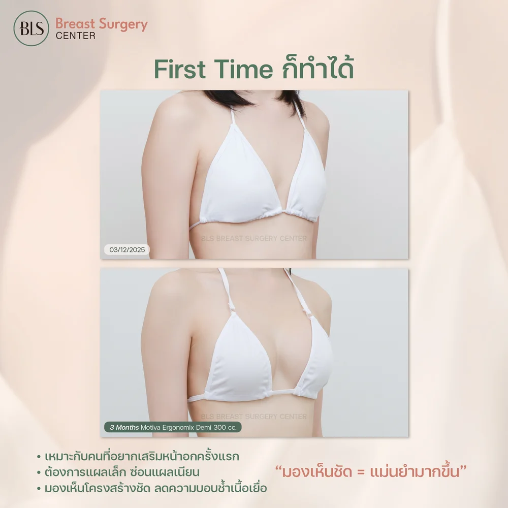 หน้าอกหลังทำ ที่ BLS ด้วยเทคนิคส่องกล้อง