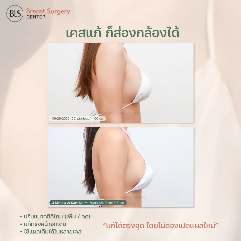 เสริมหน้าอกส่องกล้อง ก่อนและหลังทำ
