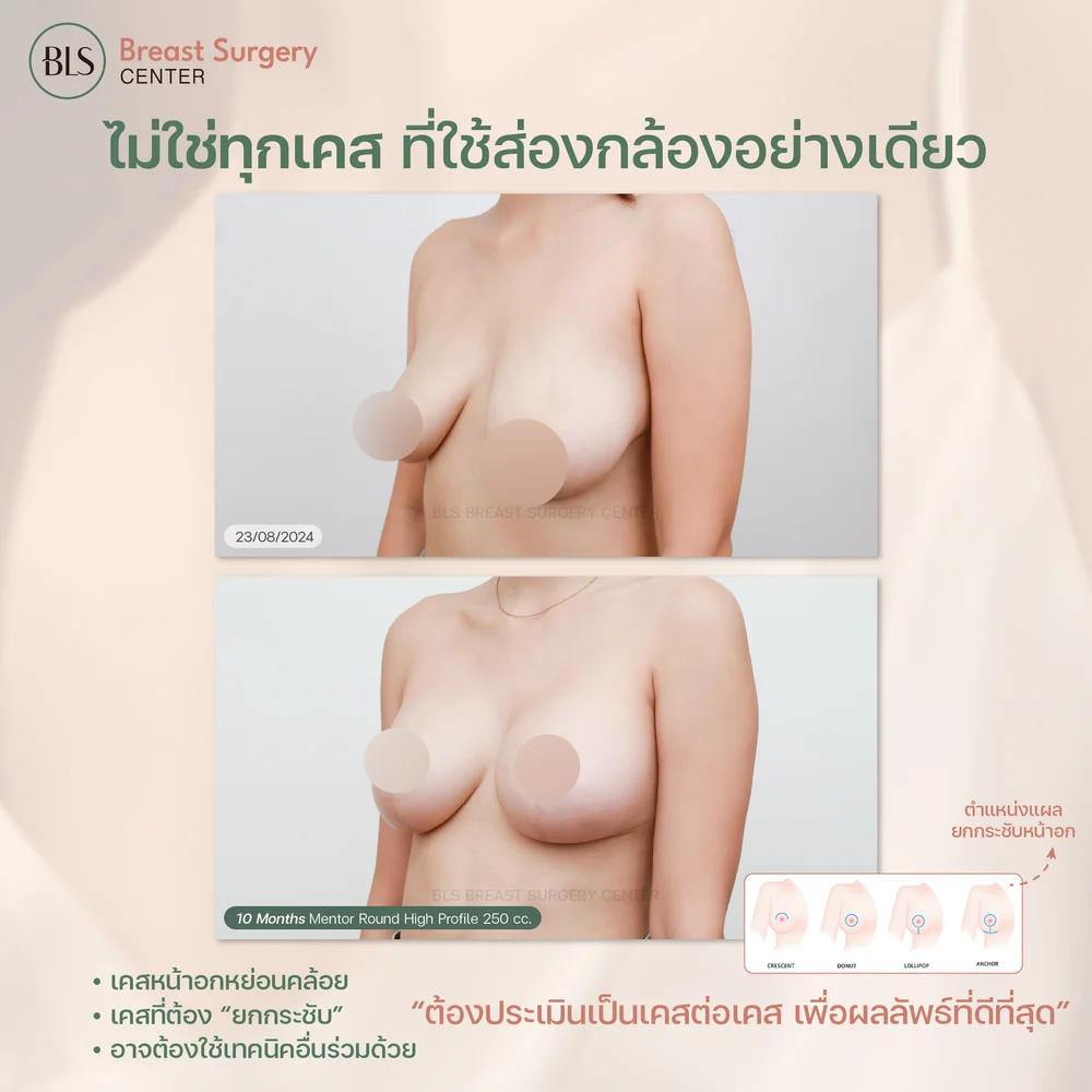 เสริมหน้าอกส่องกล้อง ราคา