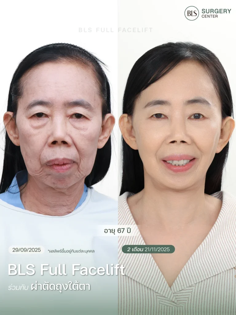 ศัลยกรรมดึงหน้าดึงคอร่วมกับแก้ปัญหาถุงใต้ตา ช่วยฟื้นฟูใบหน้าอย่างเป็นธรรมชาติ