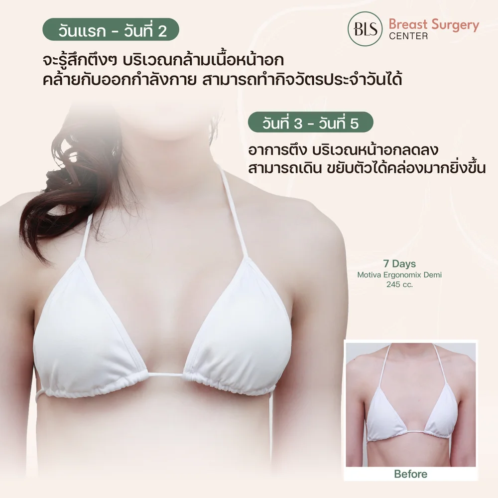 เสริมหน้าอกพักฟื้นกี่วันถึงหายเป็นปกติ