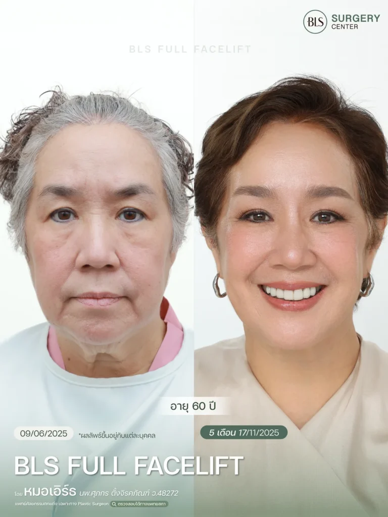 รีวิวดึงหน้าดึงคอ ช่วยยกกระชับใบหน้า ลดความหย่อนคล้อย และปรับกรอบหน้าให้ชัดขึ้น