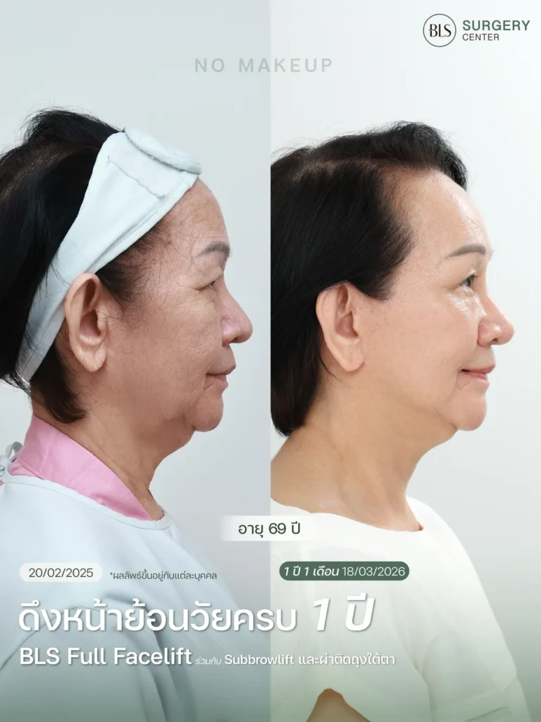 รีวิวศัลยกรรมดึงหน้าดึงคอ ช่วยยกกระชับใบหน้า ลดริ้วรอย และปรับกรอบหน้าให้ชัดขึ้น