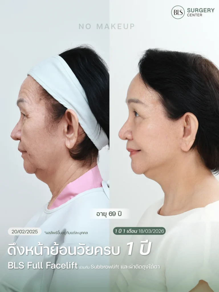 รีวิวศัลยกรรมดึงหน้าดึงคอ ช่วยยกกระชับใบหน้า ลดริ้วรอย และปรับกรอบหน้าให้ชัดขึ้น