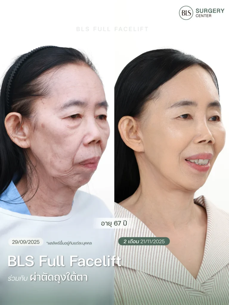 ศัลยกรรมดึงหน้าดึงคอร่วมกับแก้ปัญหาถุงใต้ตา ช่วยฟื้นฟูใบหน้าอย่างเป็นธรรมชาติ