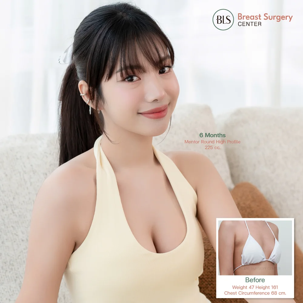 รีวิวประสบการณ์ทำศัลยกรรมหน้าอกกับคลินิกชั้นนำในกรุงเทพ