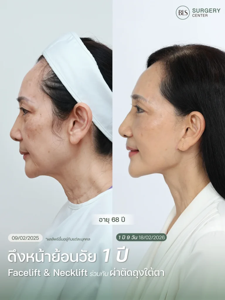 ผลลัพธ์ศัลยกรรมดึงหน้าดึงคอ ช่วยยกกระชับใบหน้าและลดความหย่อนคล้อยอย่างเป็นธรรมชาติ