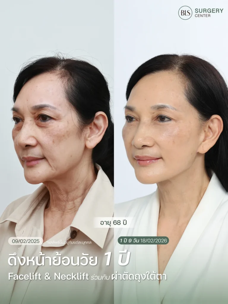 ผลลัพธ์ศัลยกรรมดึงหน้าดึงคอ ช่วยยกกระชับใบหน้าและลดความหย่อนคล้อยอย่างเป็นธรรมชาติ