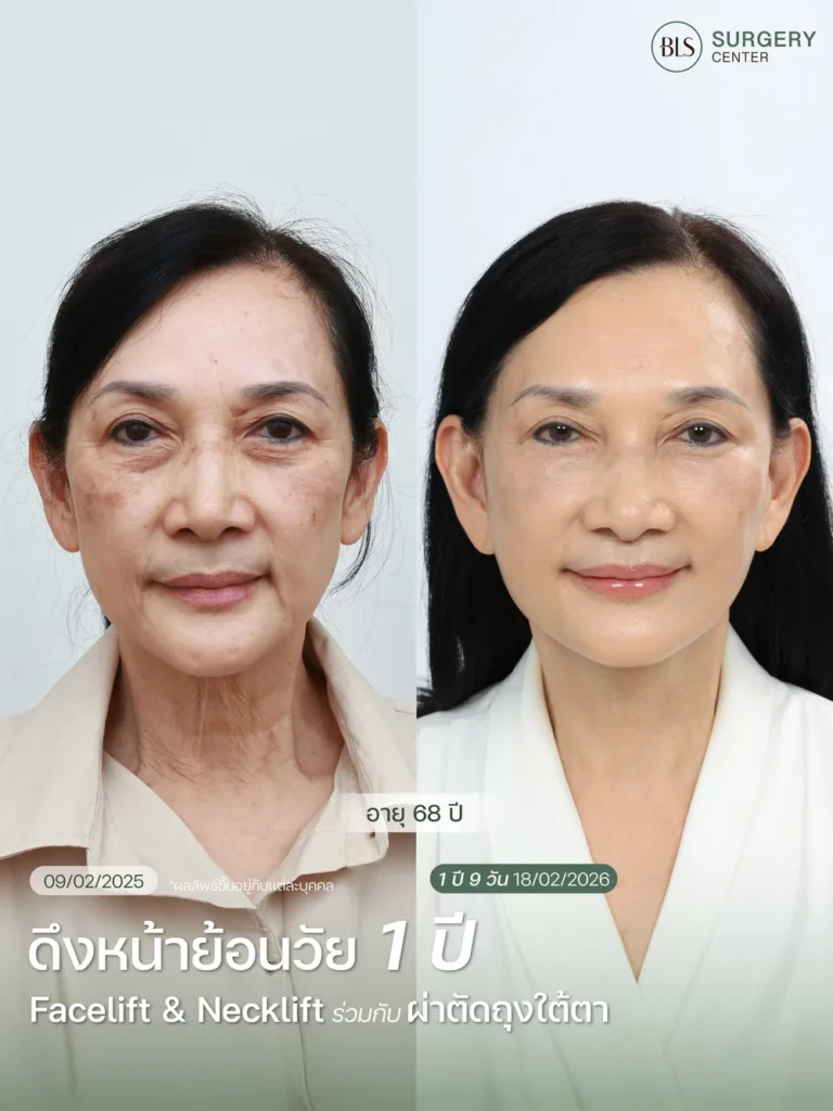 ผลลัพธ์ศัลยกรรมดึงหน้าดึงคอ ช่วยยกกระชับใบหน้าและลดความหย่อนคล้อยอย่างเป็นธรรมชาติ