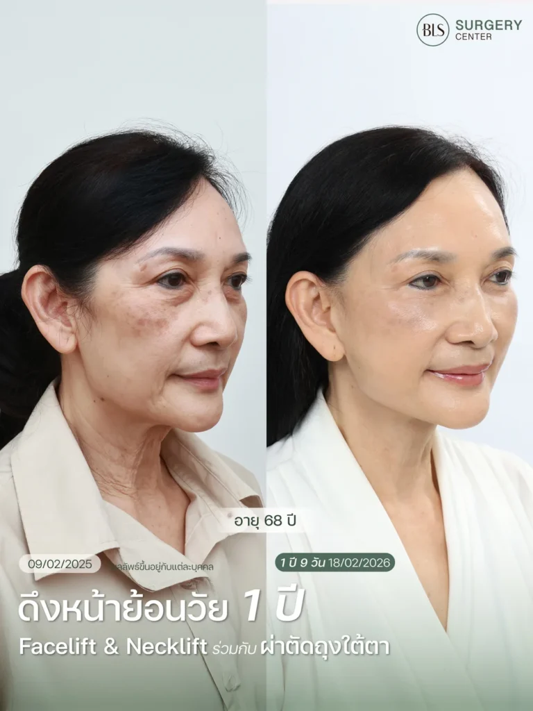 ผลลัพธ์ศัลยกรรมดึงหน้าดึงคอ ช่วยยกกระชับใบหน้าและลดความหย่อนคล้อยอย่างเป็นธรรมชาติ