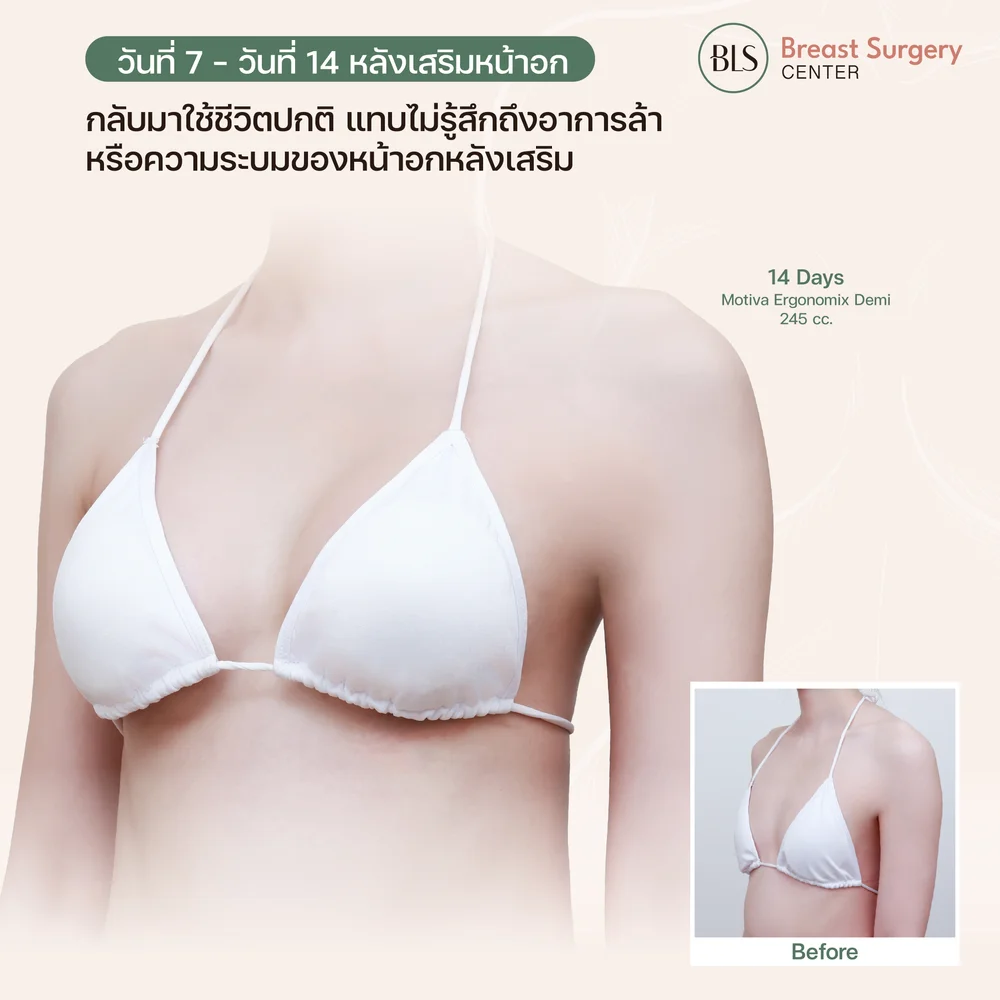 เสริมหน้าอกแบบไหนพักฟื้นน้อยที่สุด