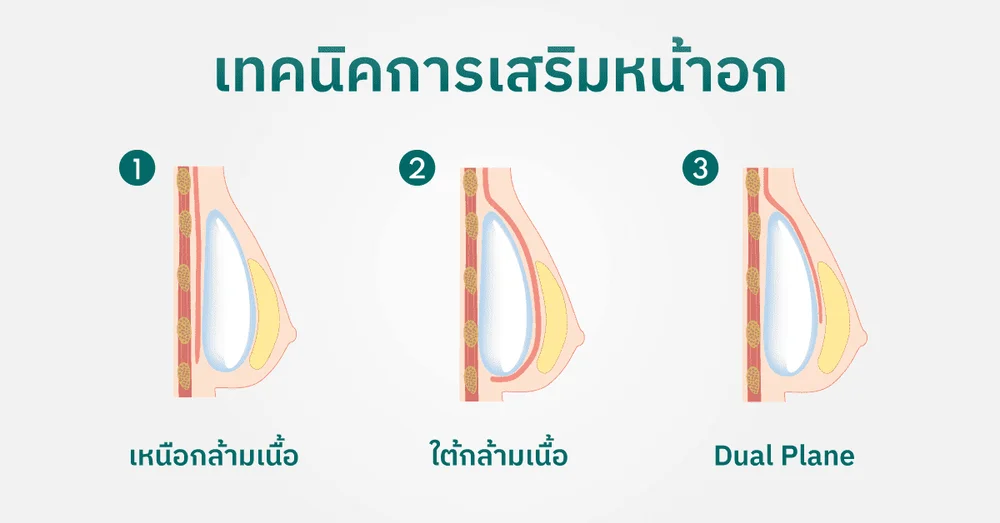 เทคนิคการเสริมหน้าอก (Breast Augmentation)
