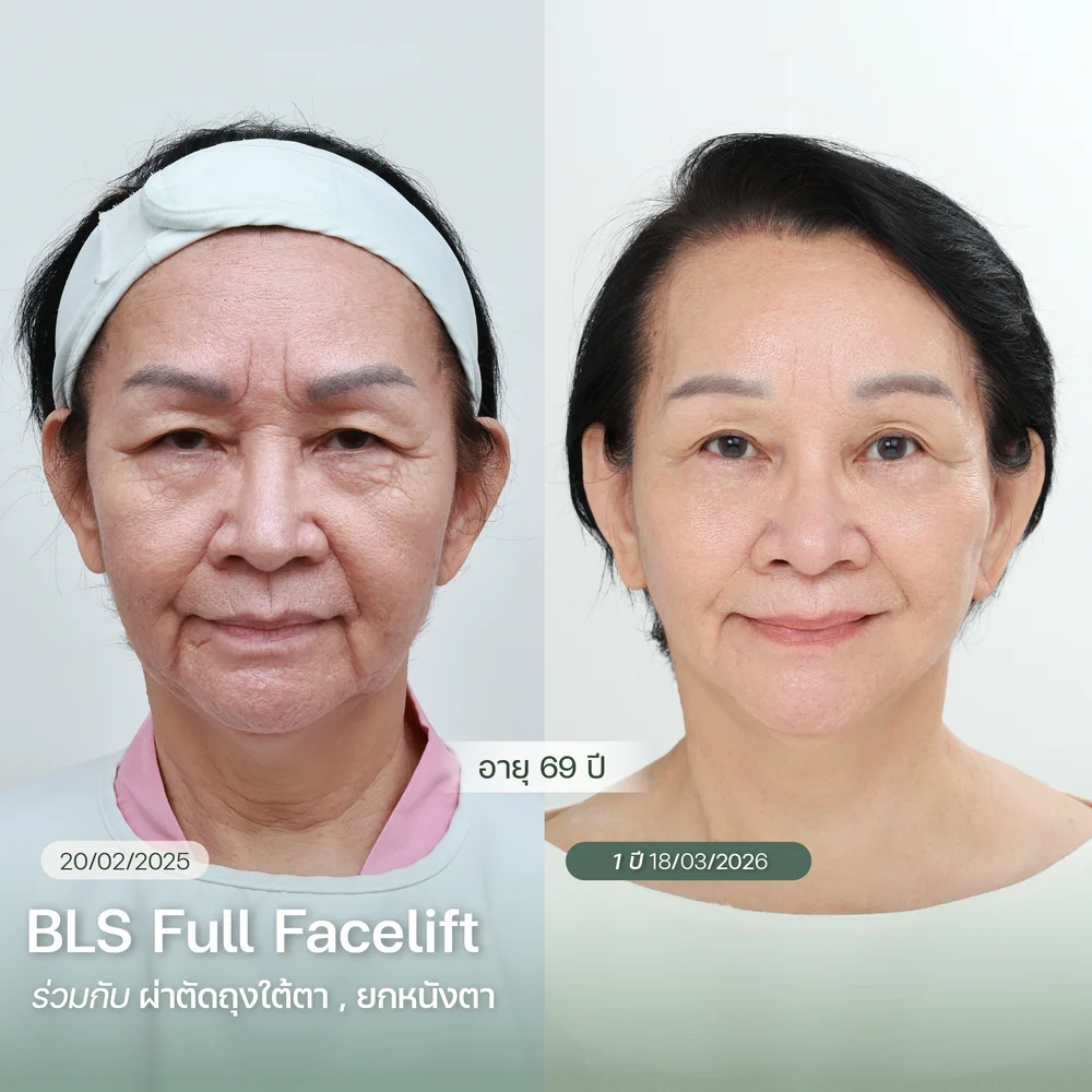 ดึงหน้าดึงคอร่วมกัน เพื่อผลลัพธ์ดูเป็นธรรมชาติ