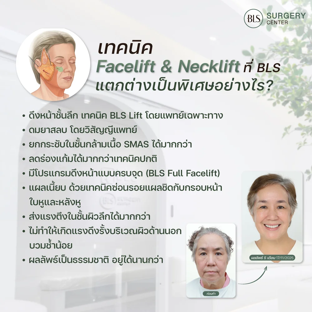ดึงหน้าชั้นลึก (Deep SMAS Facelift) คืออะไร?