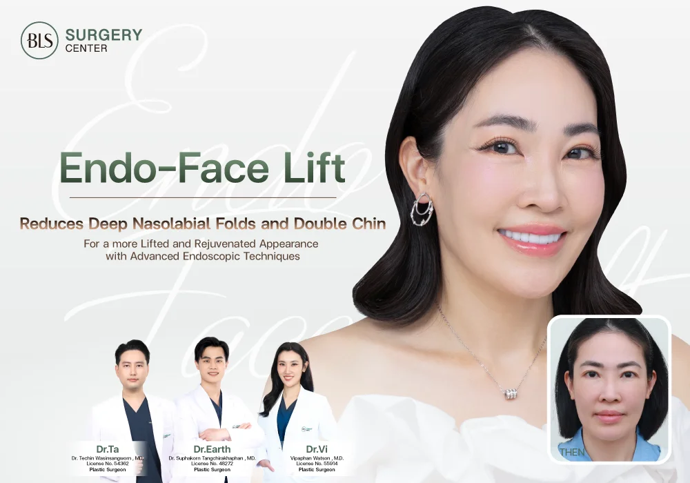 Say goodbye to deep nasolabial folds and double chin with Endo-Face Lift
