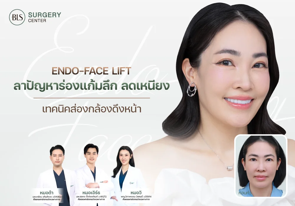 ลาปัญหา ร่องแก้มลึก ลดเหนียง ส่องกล้องดึงหน้า Endo-Face Lift