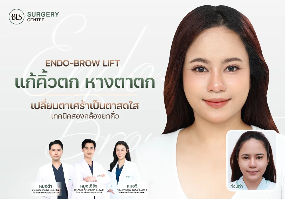 แก้คิ้วตก ตาตก ส่องกล้องยกคิ้ว Endobrow Lift