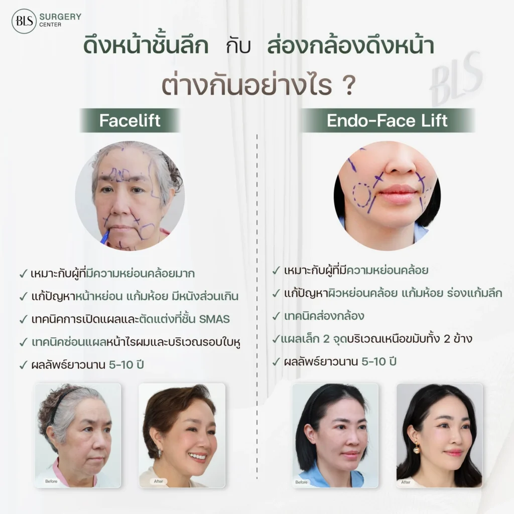 ดึงหน้าชั้นลึก เทคนิค Deep SMAS vs ส่องกล้องดึงหน้า (Endo-Face Lift)