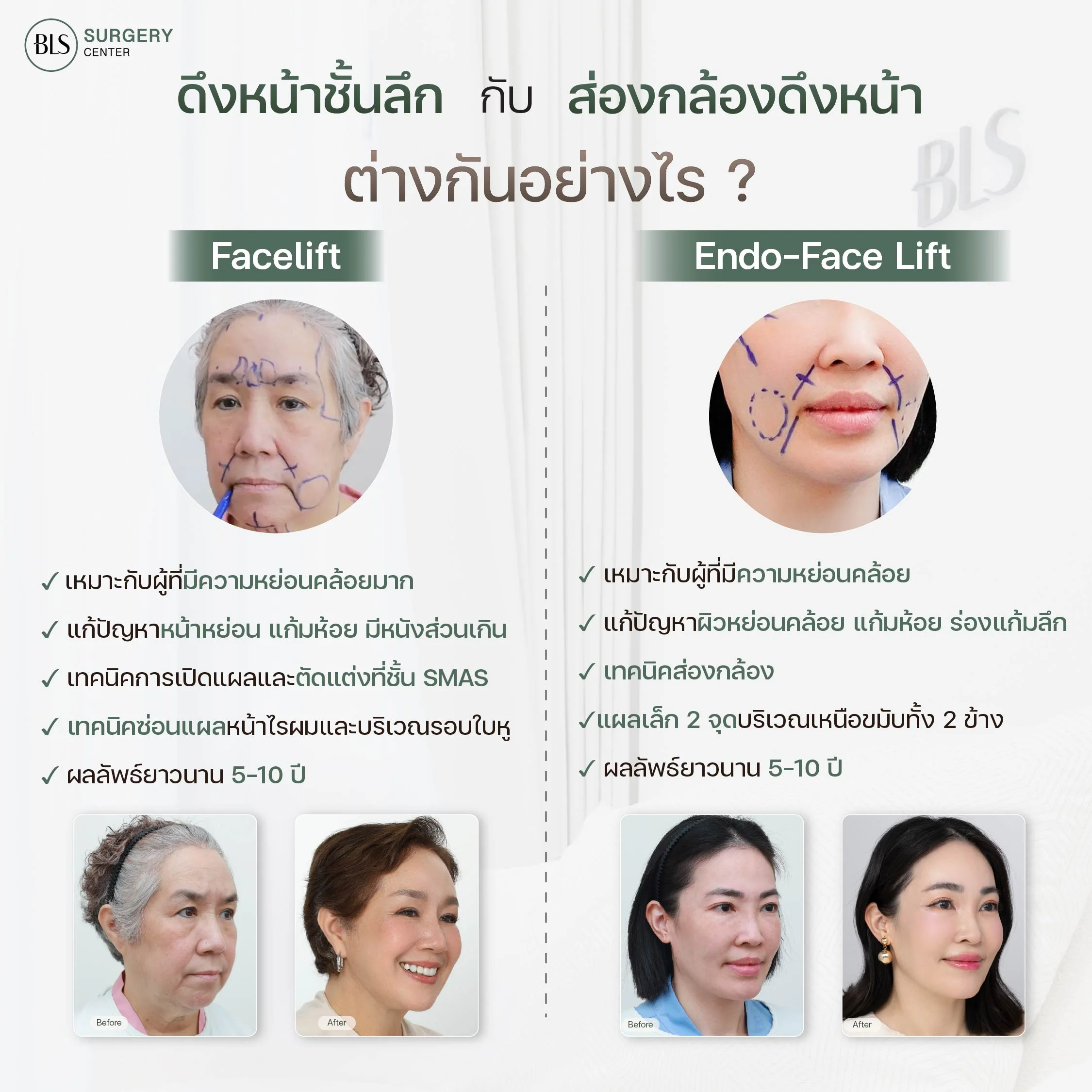 ส่องกล้อง ดึงหน้า Endo-Face-Lift กับ Facelift ยกกระชับใบหน้า ต่างกันอย่างไร?
