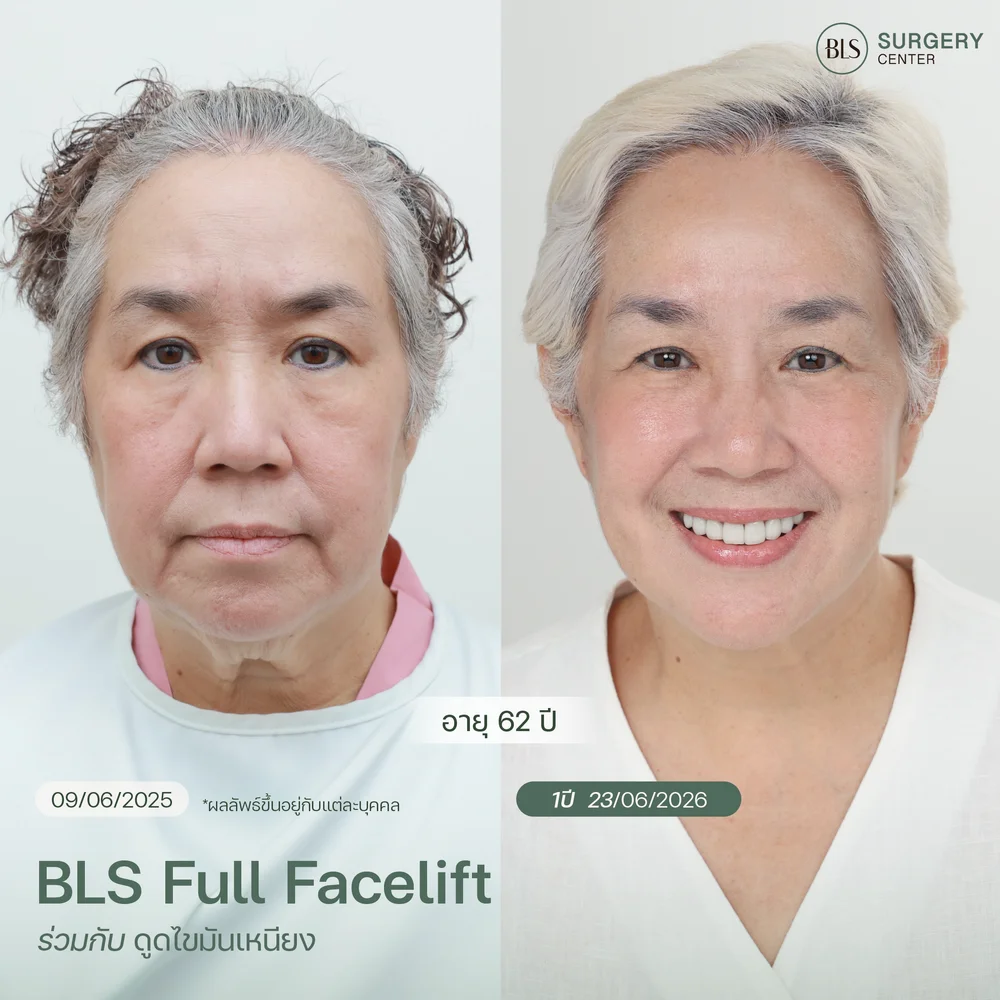 ดึงหน้า คืออะไร? แม่เขื่อน K-OTIC ดึงหน้า BLS Full Facelift