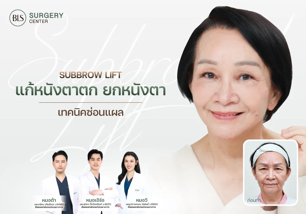 Subbrow Lift แก้หนังตาตก