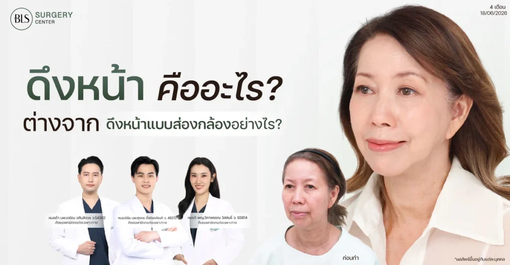 ดึงหน้า คืออะไร? ต่างจากดึงหน้าแบบส่องกล้องอย่างไร?