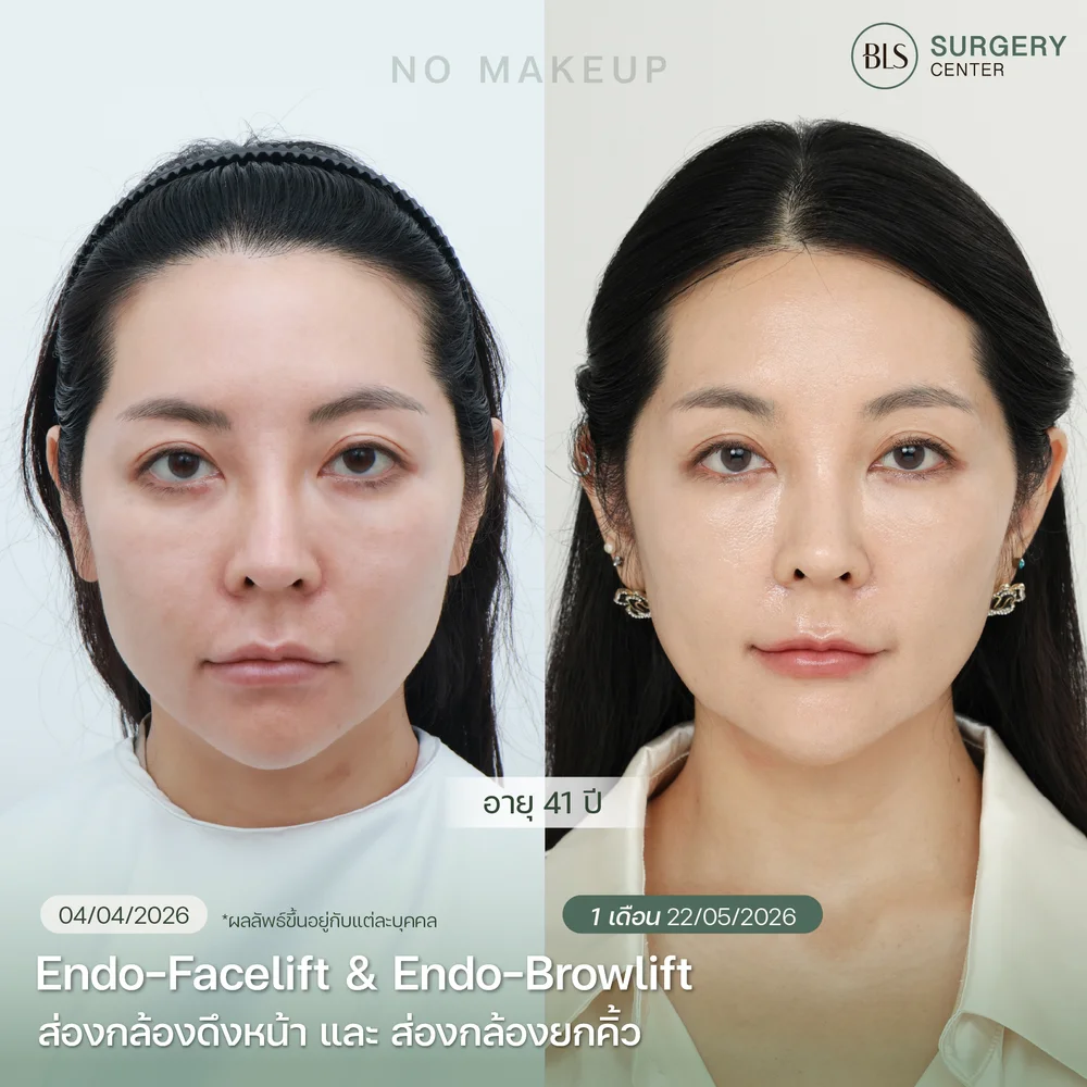 Endo-Face Lift เหมาะกับใครบ้าง?