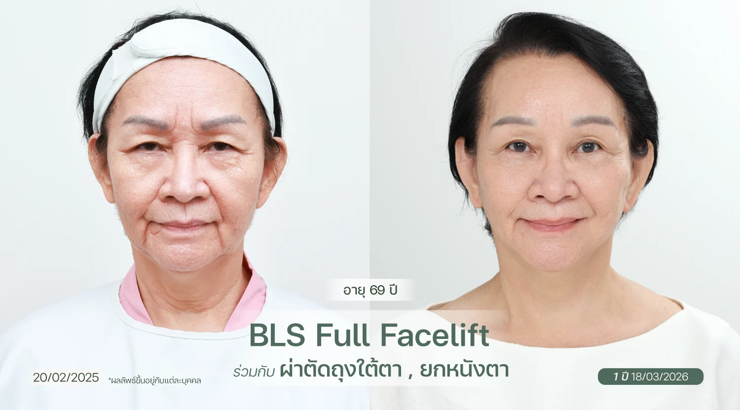 BA-web-Kแม่เตียง