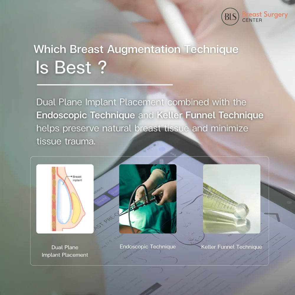 Breast Augmentation reviews using Endoscopic Technique with Dual Plane