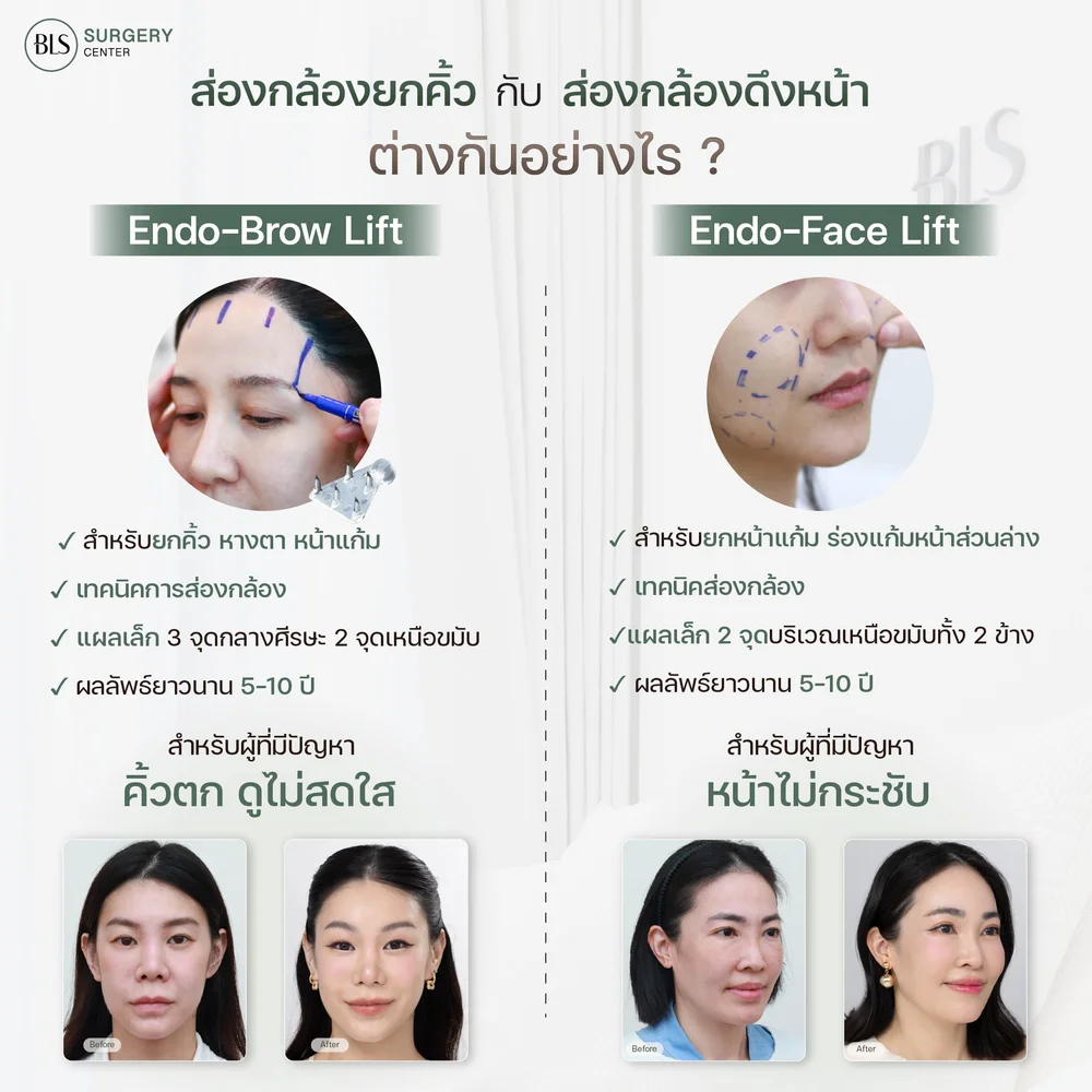 ผ่าตัดยกคิ้วมีกี่แบบ ส่องกล้องยกคิ้ว vs ส่องกล้องดึงหน้า