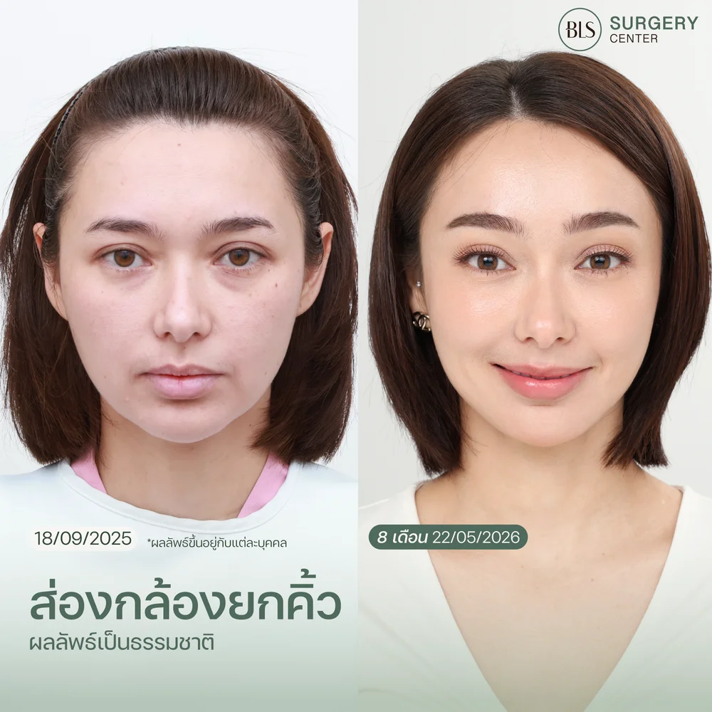 การผ่าตัด EBL คืออะไร