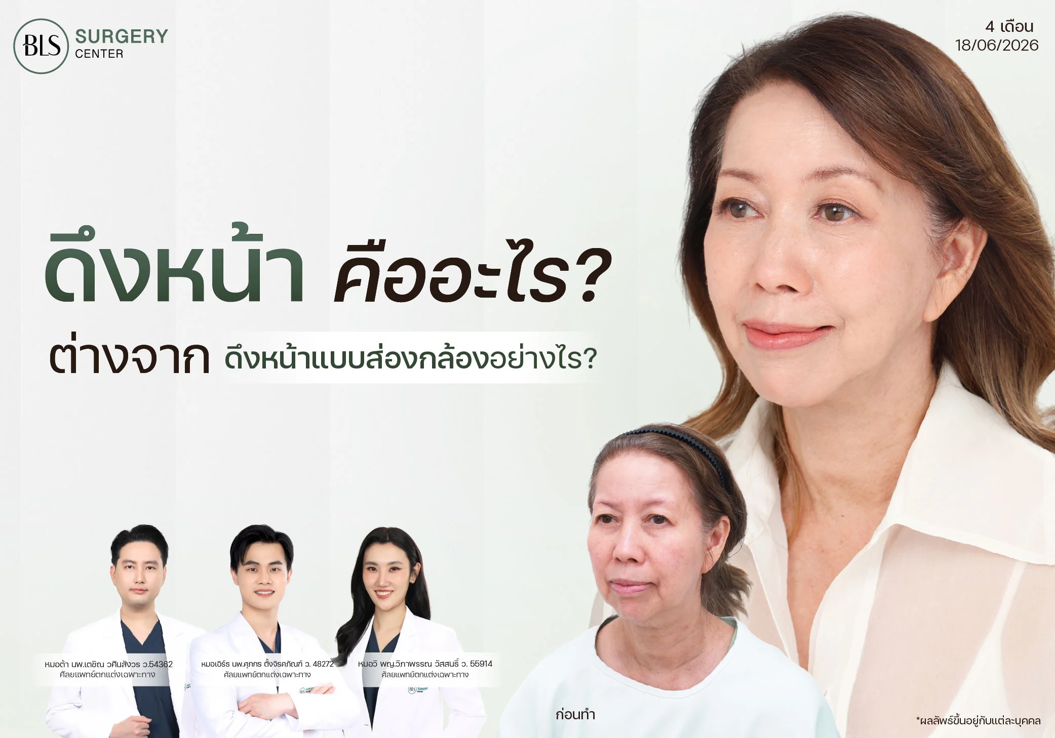 ดึงหน้า คืออะไร? ต่างจากดึงหน้าแบบส่องกล้องอย่างไร? เปรียบเทียบ Facelift vs Endo-Face Lift เลือกแบบไหนดี