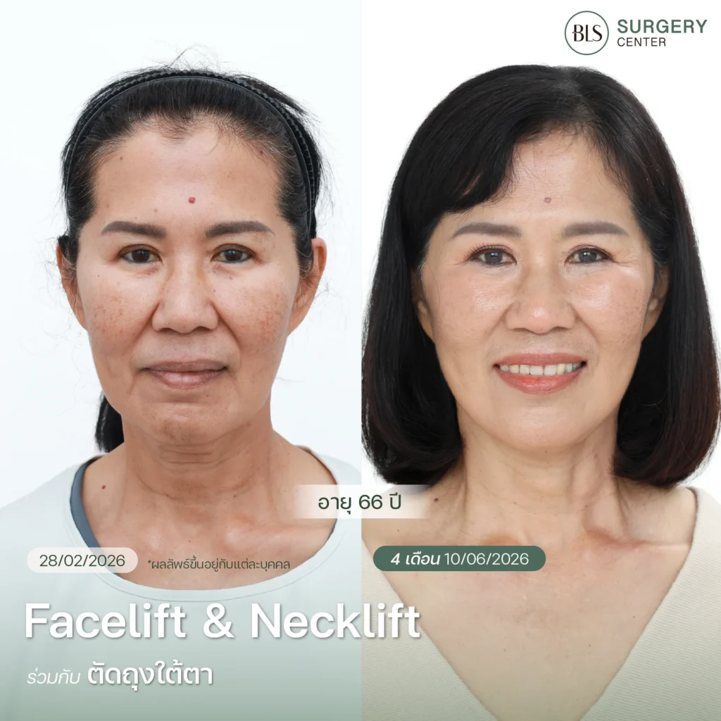 รีวิวเคส Facelift & Necklift ร่วมกับหัตถการยกกระชับใบหน้าอื่นๆ ที่ BLS Surgery Center
