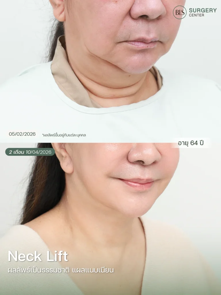 Necklift คืออะไร?