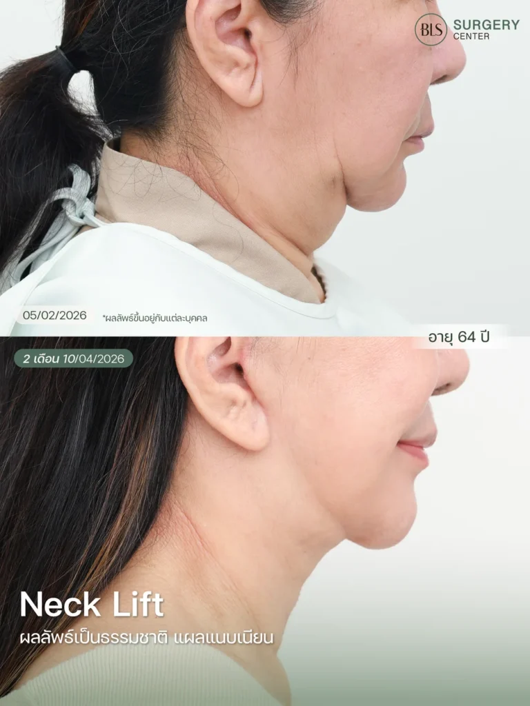 Necklift คืออะไร?