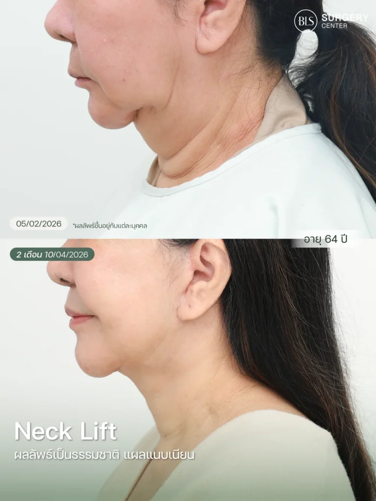 Necklift คืออะไร?