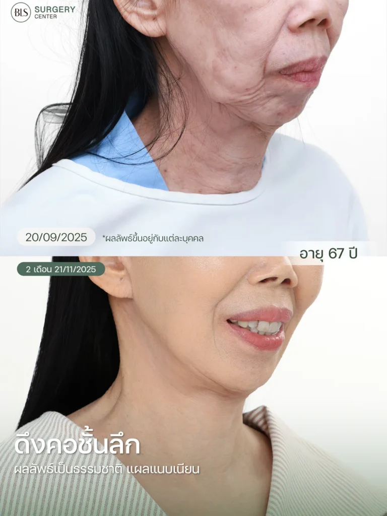 Necklift คืออะไร?