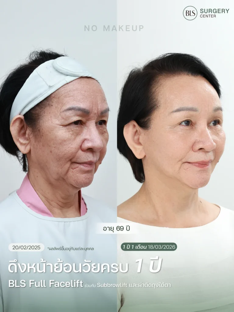 Necklift คืออะไร?